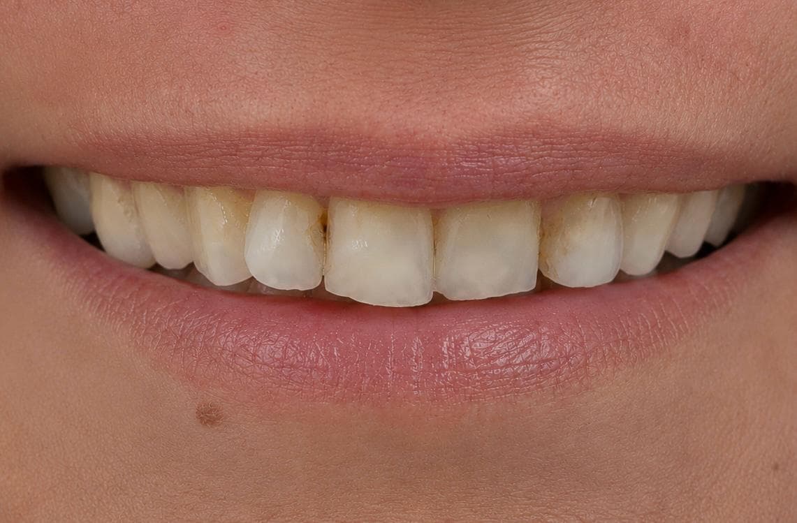 Buzëqeshja e një pacienti para trajtimit në Doa Dentalcare, me dhëmbë të konsumuar dhe të zverdhur